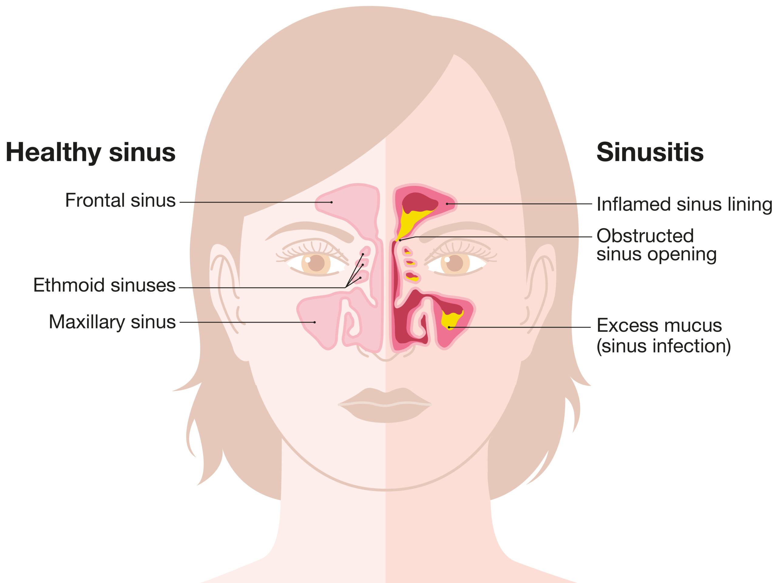 Sinusitis Treatment in the Bay Area