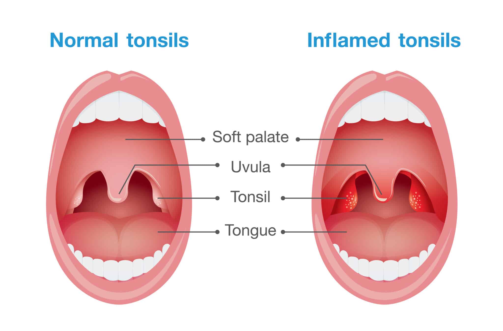 strep-throat-treatment-high-point-strep-throat-test-lexington